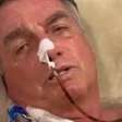 Cirurgia de Bolsonaro já dura 6 horas; ex-presidente passa por procedimento para reconstruir parede abdominal