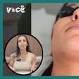 Depilação a laser para adolescentes: quando é indicado?