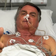 Cirurgia de Bolsonaro no domingo foi a mais longa desde a facada em 2018