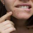 Alimentos que provocam acne; saiba quais são e o que fazer para evitar a condição
