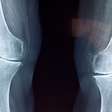 Novo biomaterial consegue fazer o que antes só se via na ficção científica: crescer cartilagem articular de grande qualidade