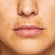 Melasma mais escuro sem tomar sol? Veja como o calor dentro de casa pode agravar o quadro das manchas na pele