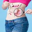 Câncer de intestino em jovens: estudo aponta as principais causas