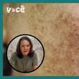 Açúcar pode piorar o melasma? Estudo revela como solucionar problema