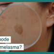 Açúcar pode piorar o melasma? Estudo revela como solucionar problema