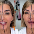 Esteticista aplica botox em apenas um lado do rosto para mostrar efeitos