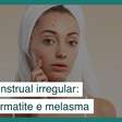 Ciclo menstrual irregular aumenta prevalência de acne, dermatite e melasma