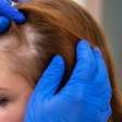 Alopecia: quando a queda de cabelo se torna um sinal de alerta