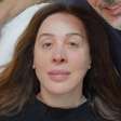 O que são fios de colágeno que Claudia Raia colocou para melhorar a flacidez no rosto?