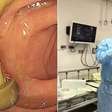 Médico encontra cogumelo crescendo em intestino de paciente; entenda