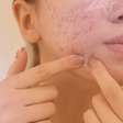 Acne na adolescência: o que é mito, o que é verdade e como tratar sem prejudicar a pele