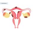 Afinal, o que é a endometriose? Explicamos tudo sobre a doença que surge no útero