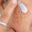 Melasma: especialista revela que clima ameno e a menor exposição solar no inverno favorecem tratamentos; veja como cuidar da pele