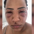 'Meu olho estava enorme': mulher tem infecção grave após erro em aplicação de ácido hialurônico nas olheiras
