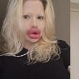 Influencer com 'maiores lábios do mundo' diz que dentistas se recusam a atendê-la: 'Decepcionada'