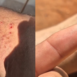 Influenciador é mordido por sucuri e dente da cobra fica preso no calcanhar; veja