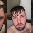 Homem fica com rosto deformado após ignorar médico e ter relação sexual após transplante capilar