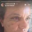 Como está a vítima dos 60 socos? Juliana posta primeira foto de seu rosto após cirurgia