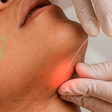 Laser subdérmico surge como alternativa à lipoaspiração