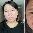 Acne gravídica: entenda a doença que transformou rosto de mulher grávida