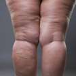 Será que é lipedema mesmo? Tire suas dúvidas aqui