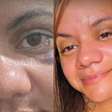 Vítima de 61 socos do ex-namorado mostra recuperação após cirurgia facial