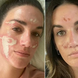 Cliente acusa esteticista das celebridades de causar queimaduras em seu rosto após peeling