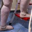 'Lipedema não é biotipo, é doença', defende cirurgiã plástica