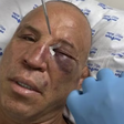 Wanderlei Silva quebra nariz e leva pontos no rosto após 'nocaute' em briga generalizada