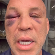 Wanderlei Silva diz que 'memória está voltando' após sair desacordado de confusão com equipe de Popó