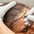 Minoxidil x Transplante Capilar: qual é a solução mais eficaz contra a calvície?
