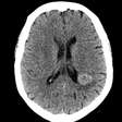 Vozes inexplicáveis salvaram mulher que tinha tumor na cabeça; entenda