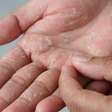 Bolhas nos pés e nas mãos pode ser disidrose; conheça problema