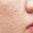 Cicatrizes de acne: como se prevenir e dicas para cuidar