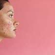 O verão está chegando! Veja como cuidar da acne na estação