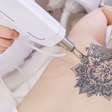 Remoção de tatuagens em alta: Conheça 4 tratamentos populares