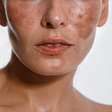 Manchas na pele: um dos maiores desafios dermatológicos