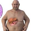 Esteatose Hepática: como a gordura se acumula no fígado