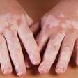 Vitiligo: causas, sintomas e como tratar as manchas na pele