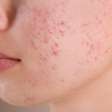 Acne hormonal: por que sua pele piora em certas épocas do mês?