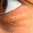 Xantelasmas: as manchas amareladas nos olhos podem indicar risco de infarto?
