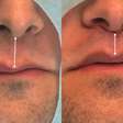 Lip Lift amplia opções de rejuvenescimento sem volume