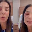 VÍDEO: Ivete Sangalo detalha cirurgia facial após acidente doméstico: 'Quebrei dois ossos'