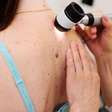Câncer de pele: 11 mitos que atrasam o diagnóstico, alerta dermatologista