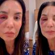 'Houve uma ruptura de osso', diz Ivete Sangalo sobre cirurgia que fez no rosto após queda no banheiro