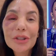 'Ela precisa se recuperar': após fratura no rosto e cirurgia recente, Ivete Sangalo é confirmada no 'BBB 26' e preocupa fãs