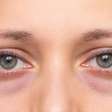 Nem sempre é cansaço: 8 motivos por trás das pálpebras inchadas