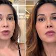 Maíra Cardi revela cirurgia complicada após sofrer abuso médico: 'Abrir minha cara inteira'