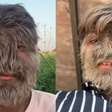 'Síndrome do lobisomem': recordista com rosto mais peludo do mundo vira influencer e expõe rotina rara