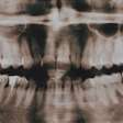 O menino com mais de 500 dentes: o caso extremo na Índia